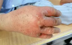 Viêm mô bào: Đừng chủ quan với những vết sưng đỏ trên da
