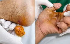 Hai người nguy kịch vì uốn ván sau khi bị... gà mổ, ngã xe