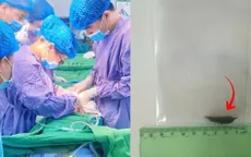 Hy hữu: Thủng ruột non do nuốt hạt táo