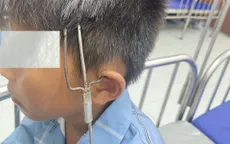Cứu bé trai bị đinh ba đâm xuyên từ tai lên thái dương