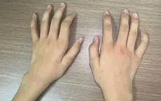 Bệnh Hirayama - nguyên nhân hiếm gặp gây teo cơ bàn tay ở người trẻ