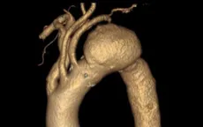 Đừng để phình động mạch chủ cướp đi cơ hội sống