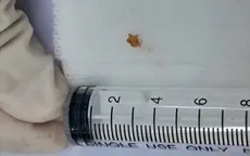 Ho hơn một tháng vì mẩu xương lươn mắc trong phế quản
