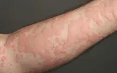 Sốc phản vệ nặng ngay sau bữa ăn