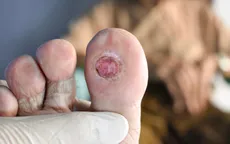 Vết loét lâu liền ở bàn chân có thể là dấu hiệu bệnh động mạch chi dưới