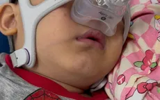 Tím tái khi ngủ, bé trai 4 tuổi phát hiện giảm thông khí do béo phì