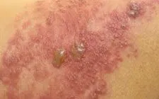 Zona thần kinh có thể biến chứng viêm màng não