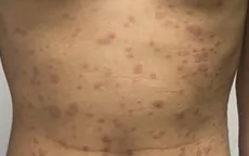 Quan hệ tình dục không an toàn, nam thanh niên phát hiện đồng nhiễm giang mai và HIV