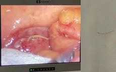 Xương cá xuyên thủng đường tiêu hóa, nằm trong ổ bụng người bệnh suốt 6 tháng