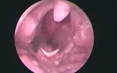 Bệnh lymphoma biểu hiện ở amidan - hiếm gặp nhưng nguy hiểm