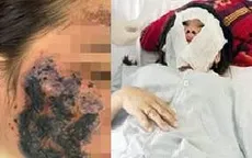 Làm đẹp liên tiếp bằng nhiều thủ thuật, người phụ nữ tổn thương gần toàn bộ khuôn mặt