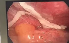 Mổ ruột thừa, bất ngờ phát hiện sán dây trong ổ bụng