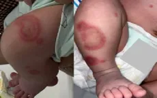 Lupus sơ sinh ở trẻ 26 ngày tuổi, cảnh giác biến chứng tim