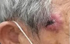 Phát hiện ung thư da từ khối u không đau ở thái dương