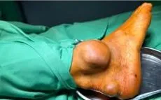Gout mạn tính: Các khối tophi lớn có thể ảnh hưởng khả năng đi lại