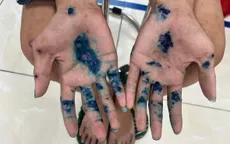 Cẩn trọng với mụn nước gây ngứa