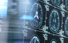 MRI có thể phát hiện sớm những dấu hiệu của Alzheimer
