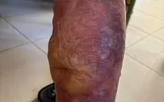 Nguy cơ tổn thương da do đắp tỏi, rượu chữa đau nhức