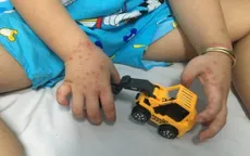 Phát hiện sớm bệnh tay chân miệng đang gia tăng ở trẻ