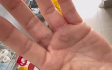 Giun đũa chó mèo có thể gây tổn thương nhiều cơ quan