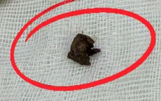 Ho, viêm phổi tái diễn vì mảnh xương bỏ quên nhiều năm trong phế quản