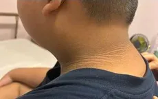 Gai đen ở trẻ béo phì: Cảnh báo nguy cơ đái tháo đường