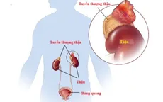 Tăng huyết áp khó kiểm soát - cảnh giác bệnh lý tuyến thượng thận
