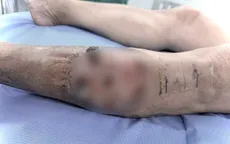 Tạo hình giúp lành vết thương hơn một năm không khỏi