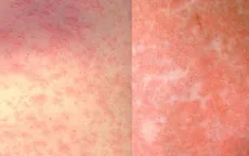 Nhận biết các giai đoạn bệnh sởi