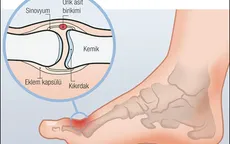 Phương pháp mới điều trị bệnh gút