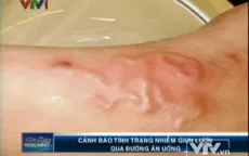 Cảnh báo bệnh nguy hiểm: Giun lươn bò dưới da 