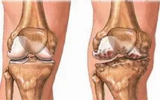 Sử dụng thuốc điều trị khớp đúng cách