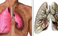 Bệnh phổi tắc nghẽn mãn tính: Dấu hiệu và cách điều trị
