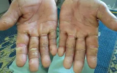 Đề nghị cấp gạo mới cho dân vùng “bệnh lạ”