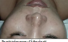 Video: Cách nhận biết mỹ phẩm chứa corticoid