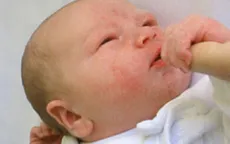 Những lưu ý chăm sóc trẻ bị chàm sữa