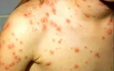 Mùa của bệnh thủy đậu