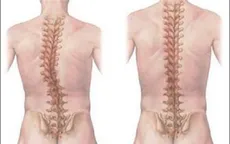 Giải pháp nào cho trẻ vẹo cột sống?