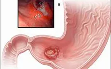 Diệt vi khuẩn H. Pylory - Thuốc gì?