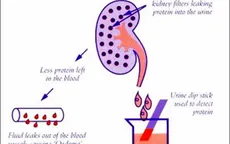 Sử dụng kéo dài steroid trong điều trị bệnh thận ở trẻ em: Lợi hay hại?