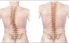Phát hiện sớm chứng vẹo cột sống ở trẻ em