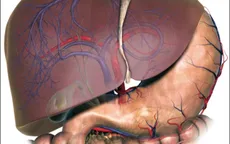 Viêm gan virus – "Kẻ giết người" âm thầm