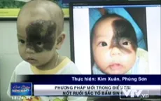 Điều trị thành công nốt ruồi bẩm sinh bằng phương pháp mới