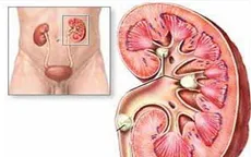 Bài thuốc Đông y điều trị hiệu quả bệnh sỏi thận