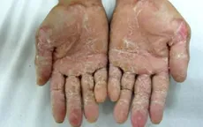 Gạo ủ là nguyên nhân gây “bệnh lạ” ở Quảng Ngãi