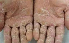 Hỗ trợ gạo cho tỉnh Quảng Ngãi khống chế "bệnh lạ"