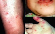 Bệnh tay chân miệng có dấu hiệu giảm