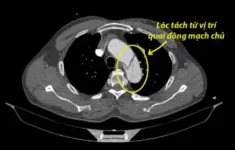 Kịp thời cứu người đàn ông bị lóc tách động mạch chủ ngực