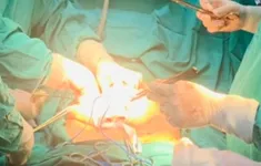 Bé trai bụng to kèm đau vùng hông lưng, đi khám phát hiện thận ứ nước nặng