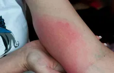 Cẩn trọng với nguy cơ phản vệ do ong đốt trong mùa hè